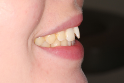 Dental Plaque