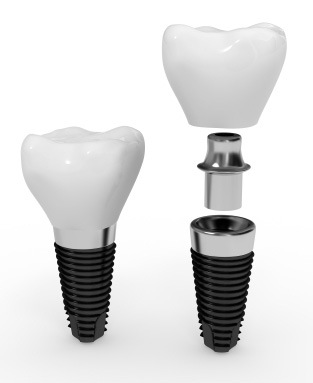 Tooth Replacement