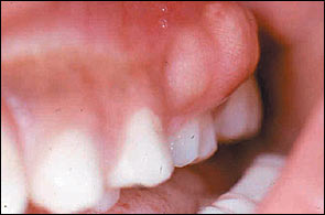 Dental Abscess Photo