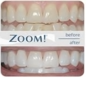 After Teeth Bleaching Example