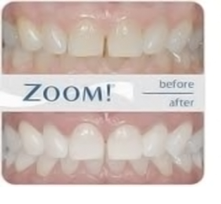 Before Teeth Whitening Example