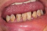 Cavities