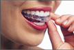 Invisalign