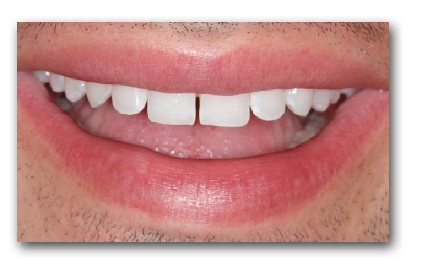 Before Snap-on-Smile