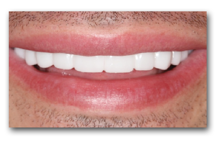 After Snap-on-Smile