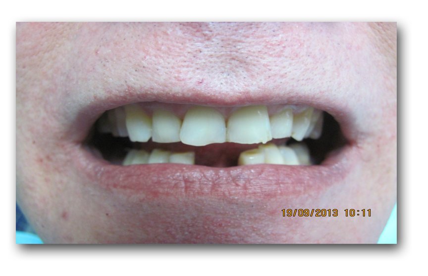 Before Snap-on-Smile