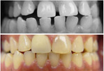 Image of invisalign treatment being performed