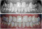 Invisalign image