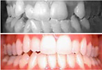 Invisalign treatment in our ville Saint Laurent office